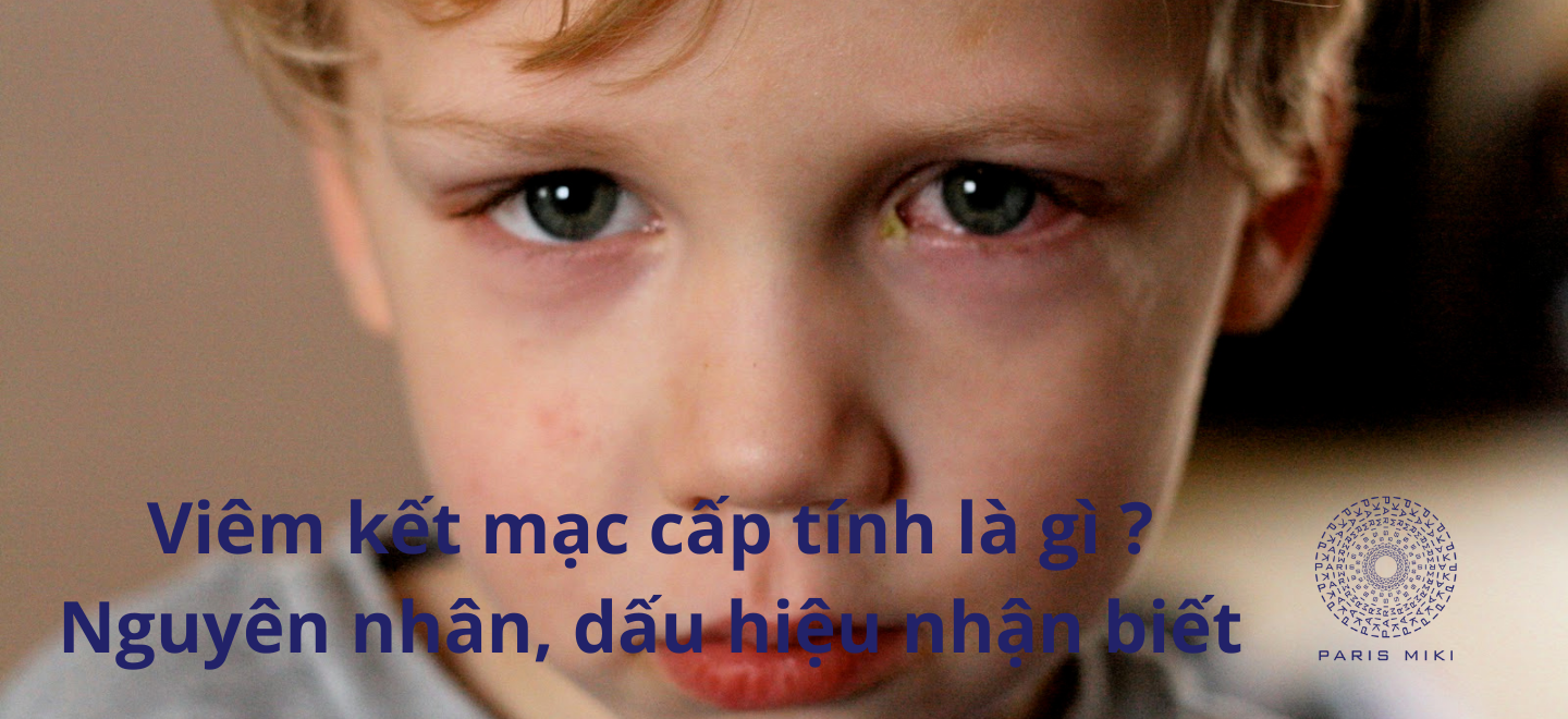 Viêm Kết Mạc Cấp Là Gì? Nguyên Nhân Và Dấu Hiệu Nhận Biết