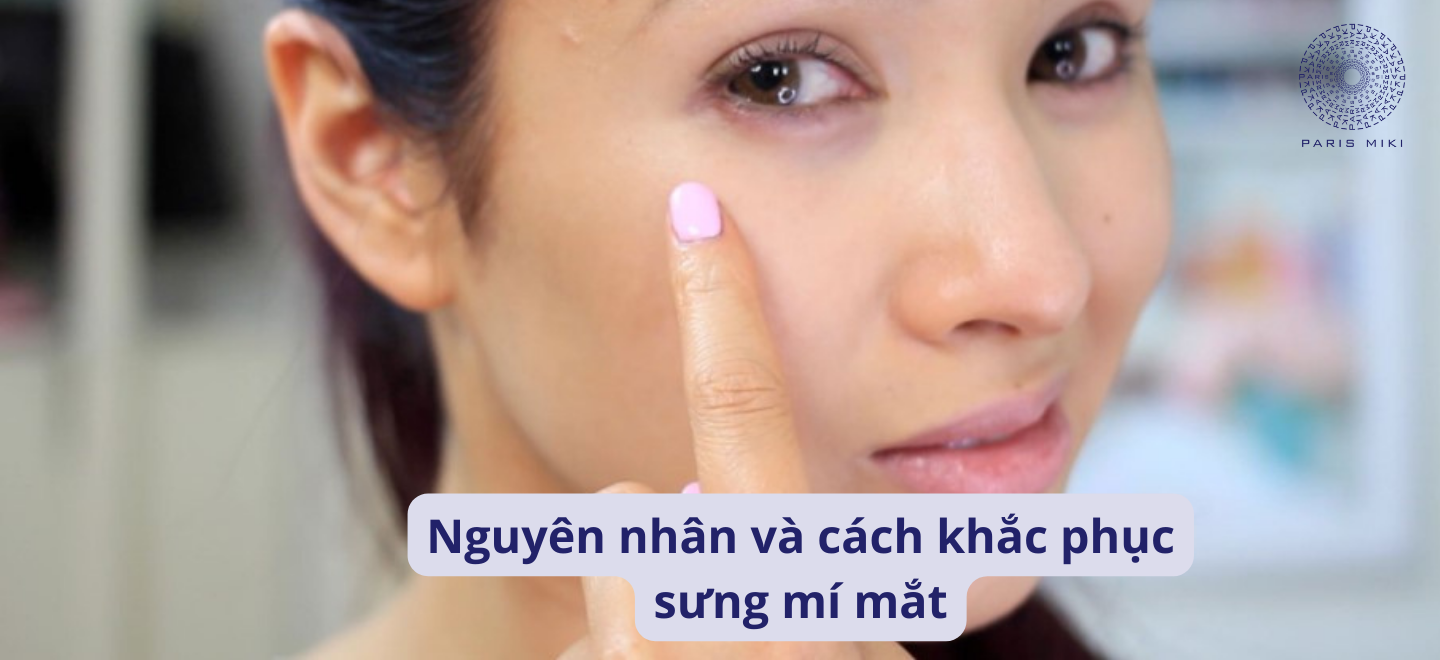 Nguyên nhân và cách khắc phục sưng mí mắt 