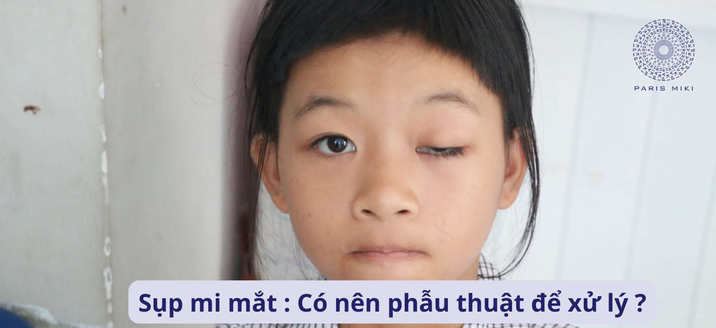 Sụp mi mắt: Có nên phẫu thuật để xử lý ?
